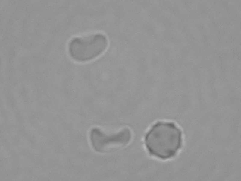 같다. Fig. 1. The microscopic photographs of ascitic fluid sediment used in 07-13 trials of 20