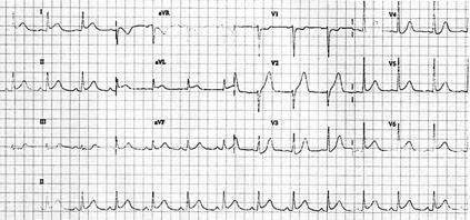 - 김현우외 6 인 : 심실중벽부무운동을보이는재발성스트레스성심근병증 1 예 - Figure 1. Electrocardiogram (ECG).