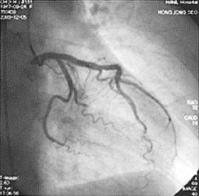 Coronary angiogram showed normal left and right coronary arteries (left coronary artery, right anterior oblique view A and right coronary