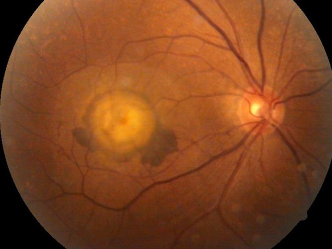 (A) Hypertensive retinopathy.