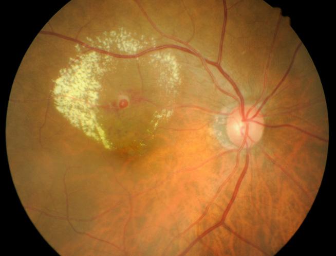 and the retinal nerve fiber layer loss.