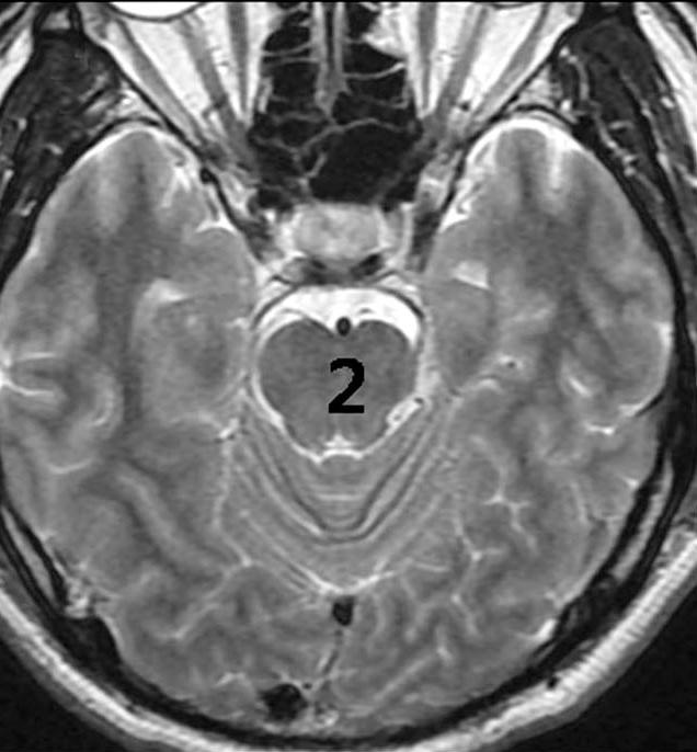 좌우 시상, 6시간 이내의 환자는 응급 MRI가 시행되었다. MRI는 T2 강조 소뇌 또는 PCA 영역은 각 1점씩, 교뇌와 중뇌에 병변이 보일 때 영상, T1 강조영상, 확산강조영상(diffusion weighted image, 는 좌우에 무관하게 각 2점씩의 점수를 감하였다(Fig.