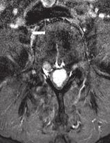 axial MR image shows