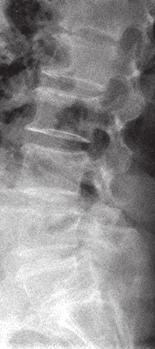 and lateral (B) radiographs