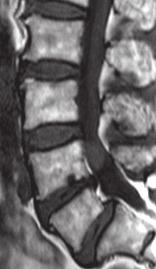 stenosis on L4-5 level and 