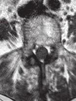 (D) Axial MR image shows