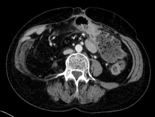 Hyun Jung Lee, et al:thalidomide in Intestinal Behcet s Disease Fig. 2.