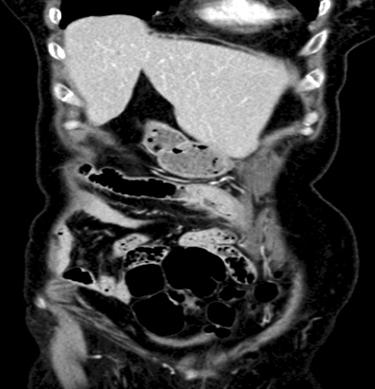 Segmental enhancing wall thickening with perienteric infiltration is noted at the