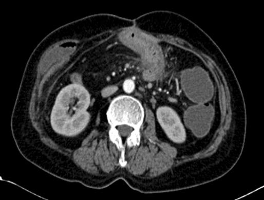 Anastomotic site ulcer and perienteric inflammation are aggravated after steroid