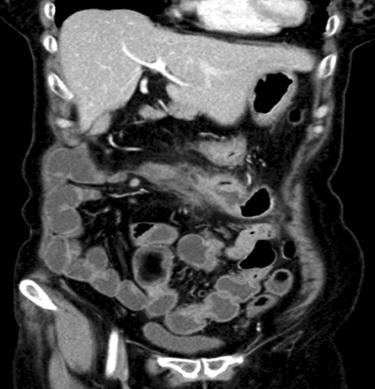 Previous perianastomotic inflammation is improved.