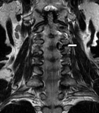Hadley 1) 는 21예의사체부검을통한연구에서 4예의사행성경추추골동맥을발견하였으며사행성경추추골동맥으로인한인접척추체의골미란소견이관찰되었음을보고한바있다.