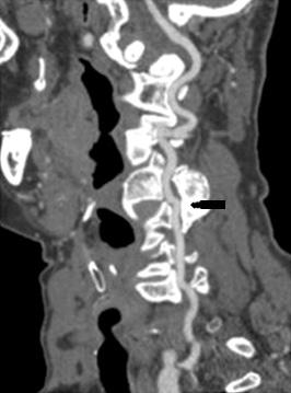 Figure 4. Tridimensional image of the left tortuous vertebral artery (arrow). 란소견이관찰되었다.