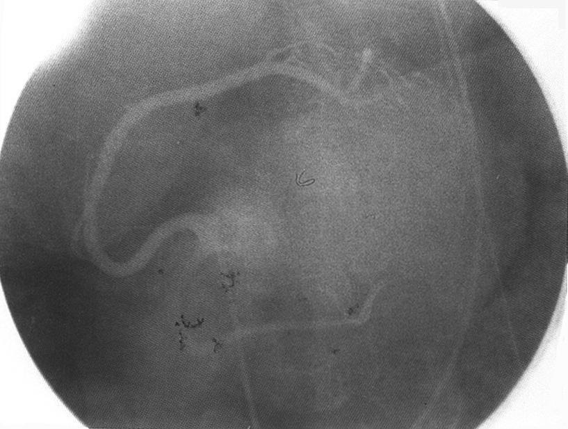 Fig. 3. Selective right coronary angiogram in the LAO view. The right coronary artery was normal. Fig. 6.