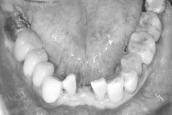posterior teeth (E) Cervical abfractions on the upper