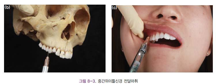 Alveolar