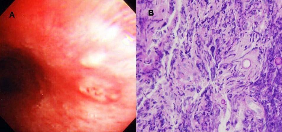 Bronchoscopic examination showed whitish, nodular lesion on bronchial mucosa of left main bronchus (A) and histologic findings of specimens obtained by bronchoscopic biopy (B) showed a marked