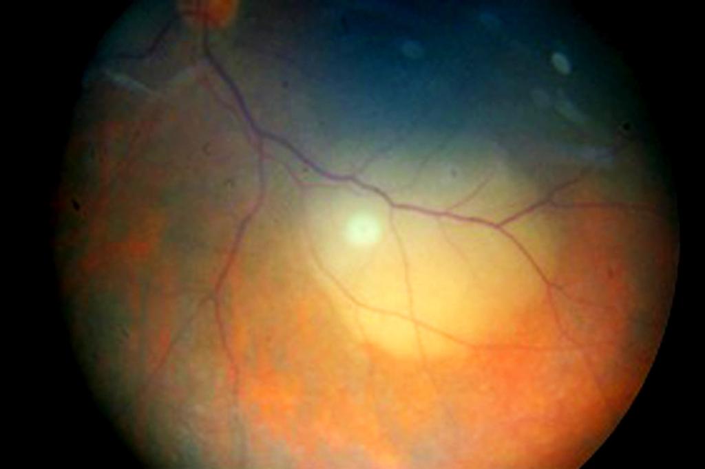 infero-temporal to the fovea with adjoining choroidal folds and exudative retinal detachment.
