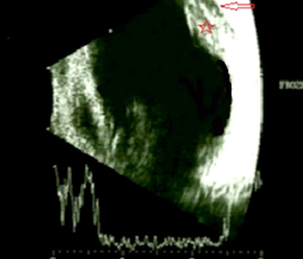 () efore treatment, -scan ultrasonography reveals a prominent dome-shaped hyperechoic nodule