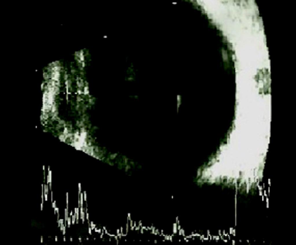 () 3 months later after treatment, -scan ultrasonography shows regression of the hyperechoic