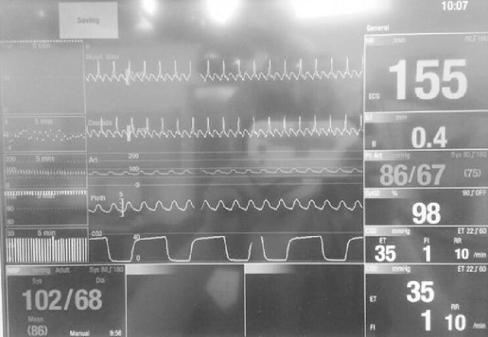 수술 2일전시행한적혈구침강속도 (erythrocyte sedimentation rate), C-반응단백 (C-reactive protein), 갑상선기능검사를포함한혈액검사상특이사항은없었고칼륨 4.9 meq/l이며기타전해질도정상범위였다. 흉부방사선소견에서도특이사항은발견되지않았다.