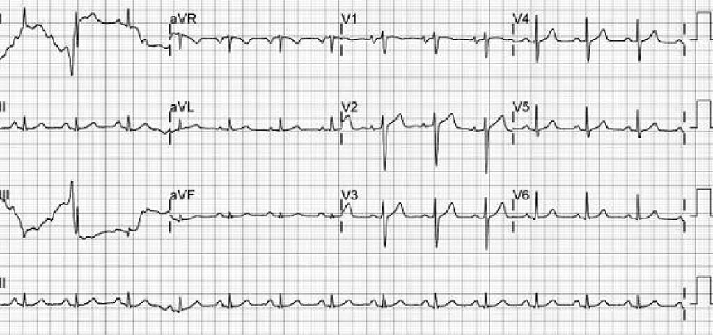 Electrocardiogram before electric cardioversion. Atrial flutter changed to atrial fibrillation with rapid ventricular responses (ventricular rate: 160 170 bpm).