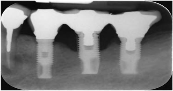 Kim HS, et al: Ten years retrospective study of Brånemark machined surface implants for posterior teeth replacement 95 월이었으며, 평균경과관찰기간은 7년 10개월이었다.
