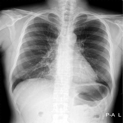 JC Park et al: Lipoid pneumonia in achalasia Figure 1. (A) On admission, chest radiography shows ground-glass appearance on right upper and lower lung field.