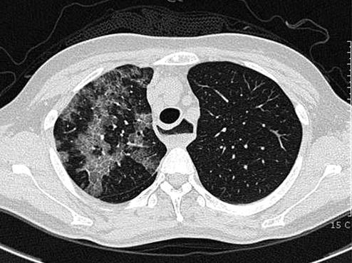 High resolution computed tomography scan of the chest shows multifocal GGA and nodule with crazy paving appearance on right upper lobe and esophageal dilatation.