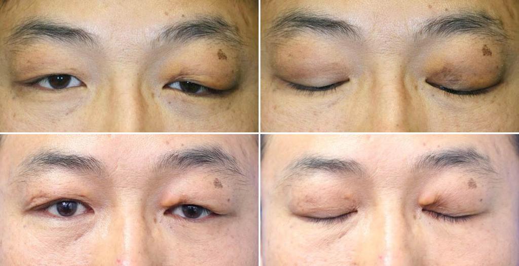 - 이승현외 : 황색육아종과면역글로불린 G4 관련안질환 - A B C D Figure 1. Clinical photographs of the patient s eyelid with the diagnosis of adult xanthogranulomatous disease.