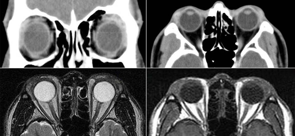 Orbital computed tomography on the first visit demonstrated bilateral soft tissue swelling with no bone invasions (A, B).