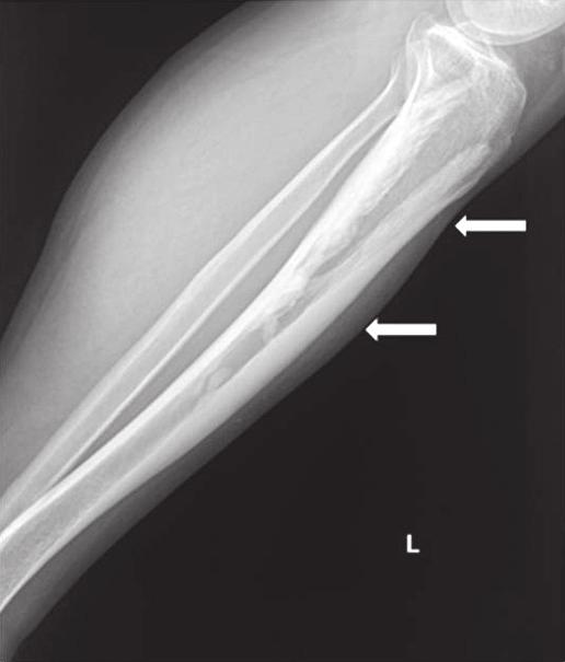 the proximal and mid portion of the tibia (arrows). Figure 2.