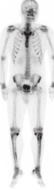 (A) T1-weighted axial image shows endosteal sclerosis causing narrowing of the canal of the tibia.