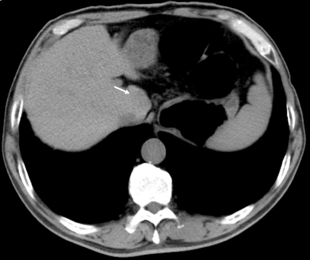 Fig. 2. Symptomatic 73-year old man with moderate important finding in CT colonography.
