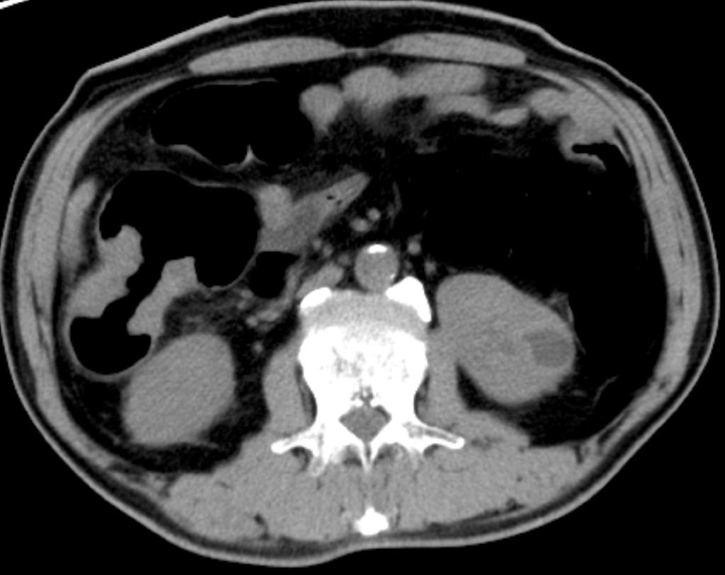 Symptomatic 76-year old man with major important finding in CT colonography. A.