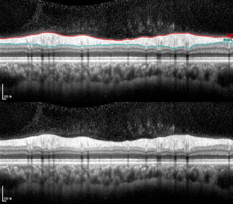 - 대한안과학회지 2016 년제 57 권제 9 호 - 포층에대해보다객관적으로정량화된평가가가능하게되었다. 8,9 망막신경섬유층의두께는각빛간섭단층촬영기에탑재된소프트웨어의경계설정알고리즘에의해측정되며최신하드웨어와소프트웨어가개발되었지만최신 SD-OCT에서망막신경섬유층두께분석시드물지않게오류가발생하고동반된안과질환이그원인이라는연구들이발표되었다.