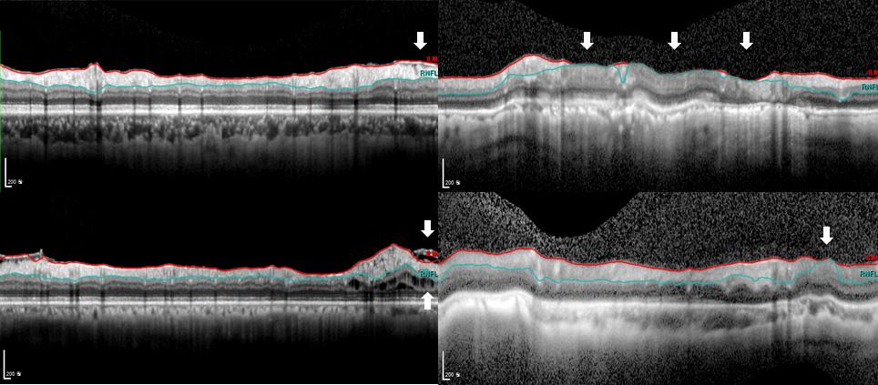- 위윤재 유영철 : 빛간섭단층촬영과망막신경섬유층경계설정오류 - A B C D Figure 2. Examples of 4 segmentation error types in Spectralis imaging for retinal nerve fiber layer thickness.