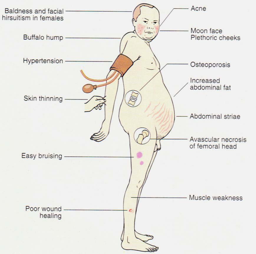 Steroid Steroid 부작용 : - 위장관 : 출혈성위궤양, 천공, 궤양성식도염 - 내분비계 : 월경불순, 조기월경, Cushing's Syndrome.