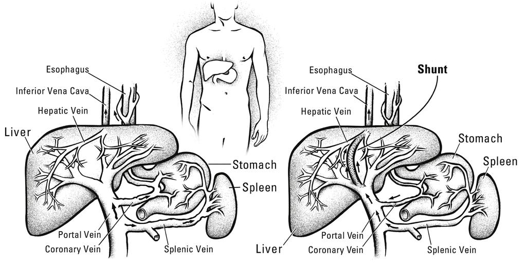 2 페이지방사선 / 영상서비스경경정맥간내문맥정맥단락술 (TIPS) 식도 하대정맥 간정맥 식도 하대정맥 간정맥 단락술 간 위 위 비장 비장 문맥정맥 관상동맥 비장정맥 간 문맥정맥 관상동맥 비장정맥 건강한간은왼쪽에나와있습니다. 단락이있는간은오른쪽에나와있습니다.