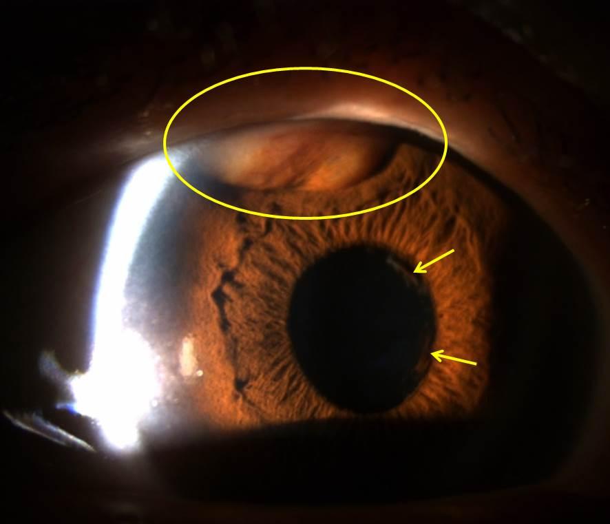 환자는 1개월전부터포도막염의심하에개인병원안과에서 1% prednisolone acetate eye drop (PredForte, llergan, Inc., Irvine, C, US) 하루 3 회점안중이었다.