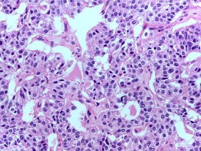 Microscopic findings of the breast. (A) Breast core biopsy reveals invasive ductal carcinoma (H&E stain, 100).