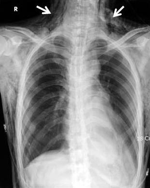 developed (B, arrow). Bronchoscopic finding shows perforated carina after cryotherapy (D, arrow). 으나추적관찰되지않았다.