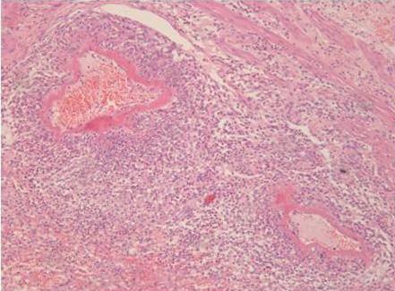 - 대한내과학회지 : 제 83 권제 1 호통권제 623 호 2012 - Figure 5. () Histopathologic analysis of the gall bladder showed small artery vasculitis with fibrinoid necrosis and infiltration of neutrophils.