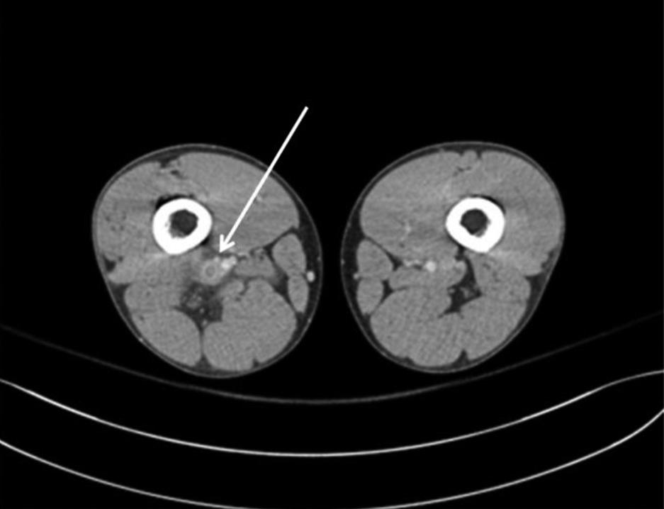 - Hyo-Ju Son, et al. ehçet s disease mimicking osteomyelitis - 증례환자 : 45세남자주소 : 오른쪽종아리통증현병력 : 5년전부터허리통증이있었으나경과관찰하였고, 1년전부터오전에 6시간이상씩앉은자세를유지하였다고하였으며, 3개월전부터오른쪽종아리가붓고통증이발생하였다.