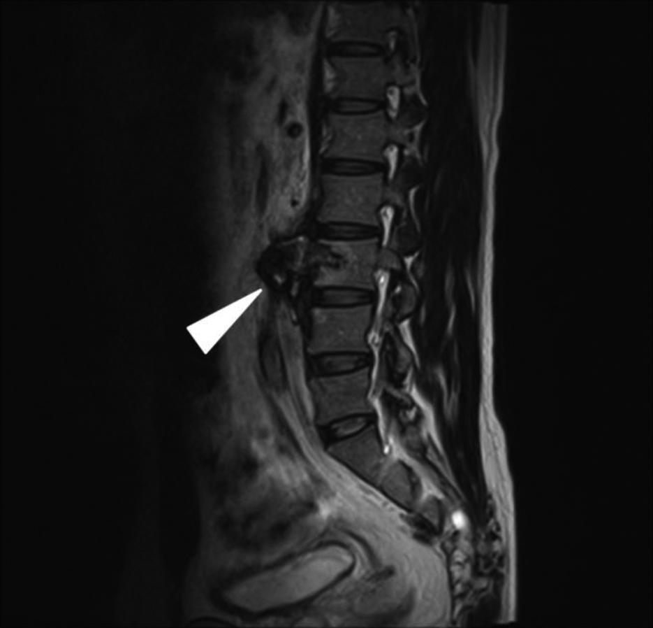 대한내과학회지: 제 93 권 제 2 호 통권 제 681 호 2018 Figure 2. T2-weighted magnetic resonance images of the spine at presentation.