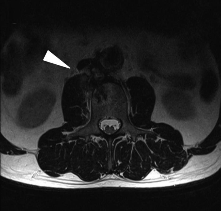 section and Y-graft interposition of abdominal aortic aneurysm) 을 시행하였다. 신장동맥 아래쪽에 있는 대동맥 및 온엉덩동 맥을 제거하고 그물막(omentum)을 결장 후방으로 위치시켜 폴리테트라플루오로에틸렌(polytetrafluoroethylene) 이식편을 덮었다.