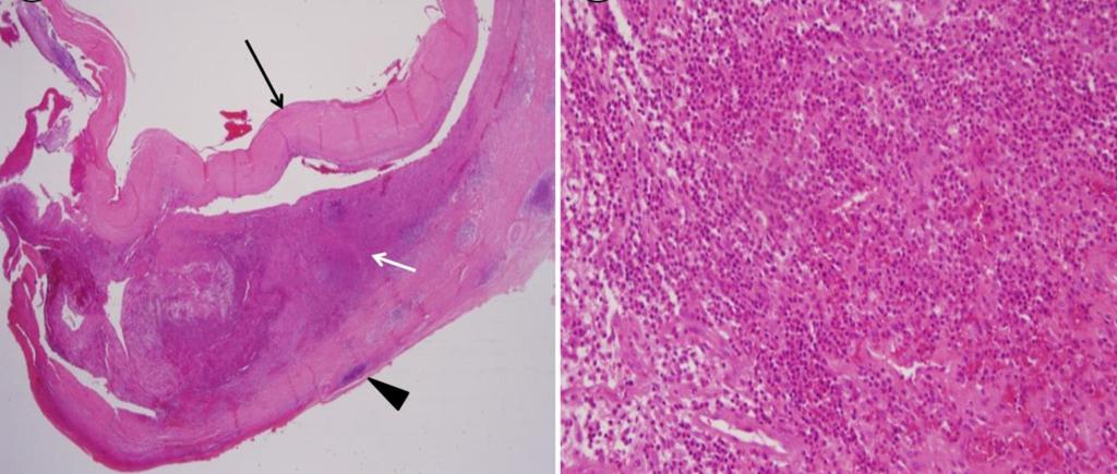 - 손효주외 6 인. 척추골수염으로오인한베체트병 1 예 - Figure 4. () Histologically, the abdominal aorta shows a mixed inflammatory pattern with severe inflammatory infiltration and atherosclerosis.