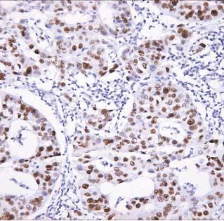 MSI in Invasive Ductal Carcinoma 81 Table 4. Correlation between MSI & p53 protein expression p53 protein expression (+) (-) MSI (+) 14 8 MSI (-) 40 38 고 찰 Fig 2.