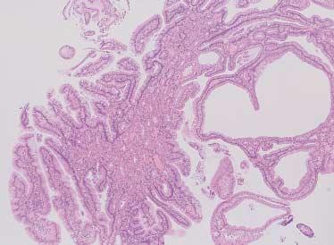 샘창자의위화생 219 A B C D Fig. 2. (A) Mild gastric metaplasia: There is a small focus of gastric metaplasia surrounded by normal duodenal absorptive epithelial cells that are forming villi.