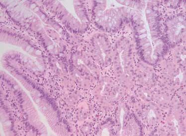 (C) Severe gastric metaplasia: A polypoid lesion of the duodenum is mostly composed of gastric epithelial cells.
