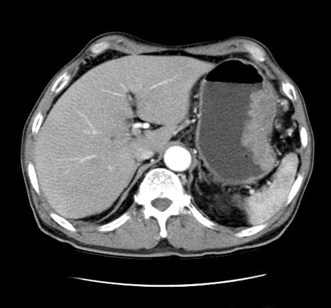 Intest Res : Vol. 9, No. 1, 2011 Fig. 1. Abdomen-pelvic CT findings of primary GI T-cell lymphoma.